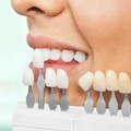 Faccette dentali a Rovigo: come ottenere un sorriso naturale senza il timore di un risultato artificiale?