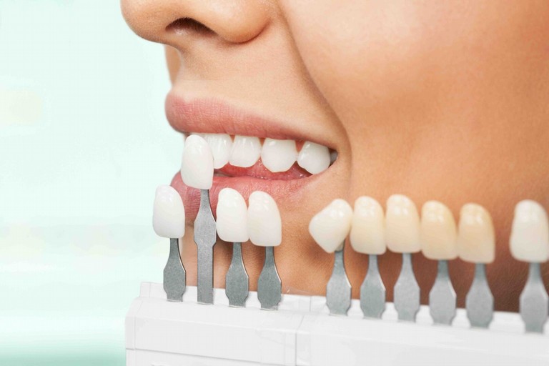 Faccette dentali